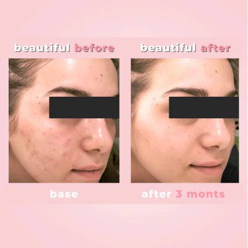 Chấm Mụn Biotrade Acnaut Active Cream (5ml)