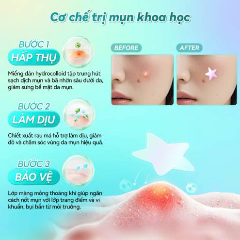 Miếng Dán Mụn Lanbena Invisible Acne Pimple Patch Hỗ Trợ Giảm Mụn, Làm Dịu Da - hình bướm