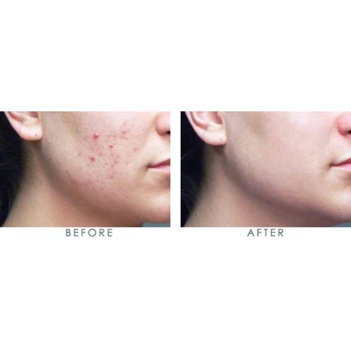 SỬA RỬA MẶT NEUTROGENA OIL-FREE ACNE WASH PINK GRAPEFRUIT FACIAL CLEANSER