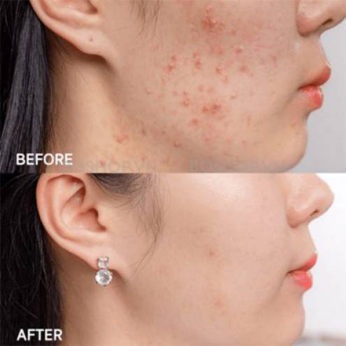 Kem Trị Mụn, Mờ Thâm Acne-Derm Kwas Azelainowy 20% 20g